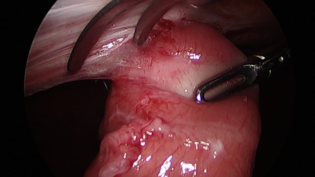 Laparoscopic pictures of the fibrinous adhesion, dark brownish ascetic