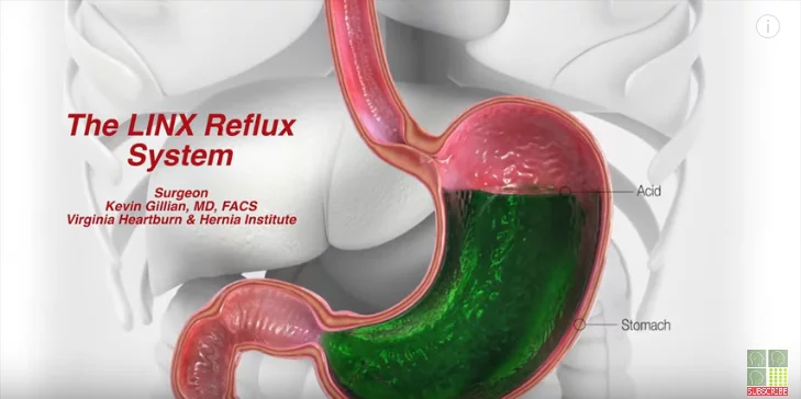 LINX procedure aniamtion adn surgical footage